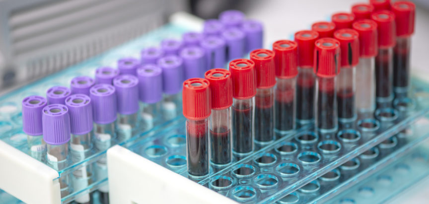 Predstavljen novi test krvi koji može otkriti 50 vrsta karcinoma prije pojave simptoma